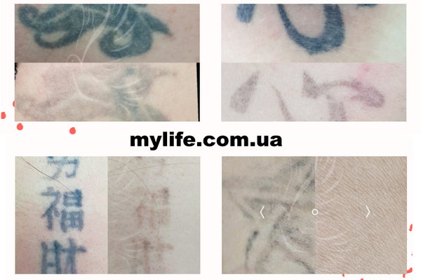 Удаление татуировок пикосекундным лазером