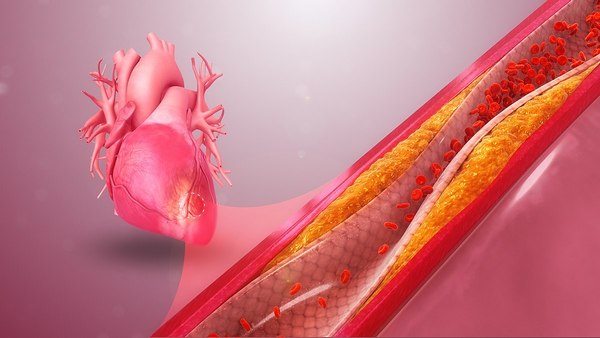 Ишемическая болезнь сердца (ИБС) является одной из самых распространен